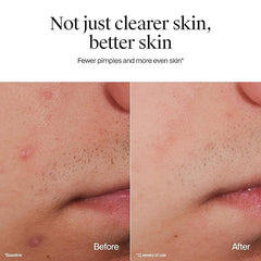Neutrogena Oil-Free Acne Face Wash, Fragrance Free, Sensitive Skin Facial Cleanser with 2% Salicylic Acid Acne Treatment for Face, 9.1 Fl Oz