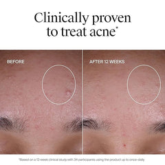 Neutrogena Evenly Clear Acne Exfoliant with Salicylic Acid & Mandelic Acid, Multi-Acid Face Exfoliating Treatment Serum Visibly Fade the look of Post-Acne Marks for A Smooth, Even Skin Tone, 1 fl. oz