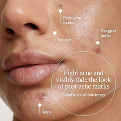 Neutrogena Evenly Clear Acne Gel Moisturizer with Salicylic Acid & N-Acetyl Glucosamine, Lightweight Non-Greasy Face Moisturizer Helps Treat Breakouts & Visibly Fade the look of Post-Acne, 1.7 fl. oz