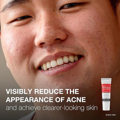Neutrogena Rapid Clear Stubborn Acne Spot Treatment Gel with Maximum Strength 10% Benzoyl Peroxide Acne Treatment Medication, Pimple Cream for Acne Prone Skin Care, 1 oz, 2 Pack