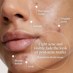 Neutrogena Evenly Clear Acne Exfoliant with Salicylic Acid & Mandelic Acid, Multi-Acid Face Exfoliating Treatment Serum Visibly Fade the look of Post-Acne Marks for A Smooth, Even Skin Tone, 1 fl. oz