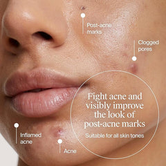 Neutrogena Evenly Clear Retinoid Adapalene Gel 0.1% Acne Spot Treatment, Once-Daily Topical Retinoid Helps Clear Breakouts & Visible Improvement in the Appearance of Post-Acne Mark, 0.5 oz